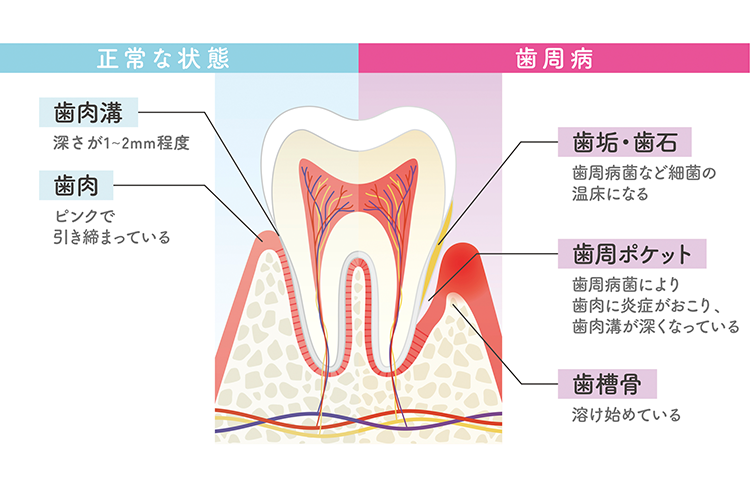 歯周病のイメージ画像